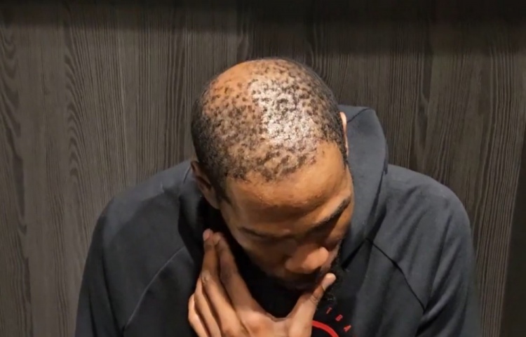 37岁还单身有原因😳！杜兰特秃顶这么严重 这发量找对象难啊